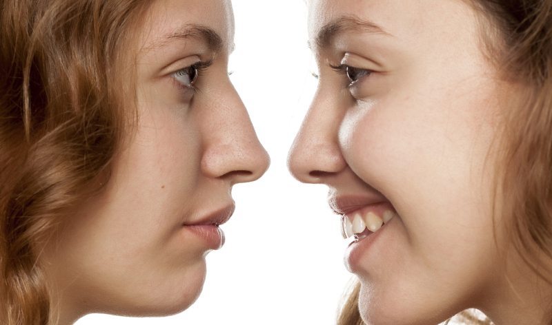 RINOPLASTIA FUNCIONAL