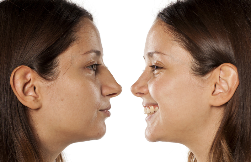 Rinoplastia - Jaime Garcia cirujano plastico